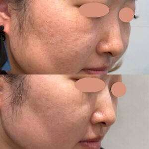 ピコフラクショナルの効果とは？毛穴・ニキビ跡・小じわへの変化、回数やダウンタイムまで解説