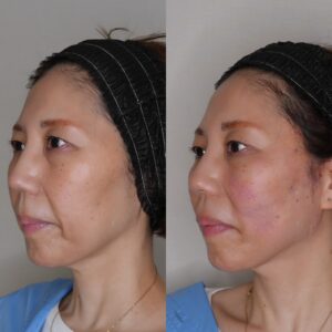 糸リフトの効果期間はどれくらい？持続年数・戻るタイミング・長持ちさせる方法を医師が解説