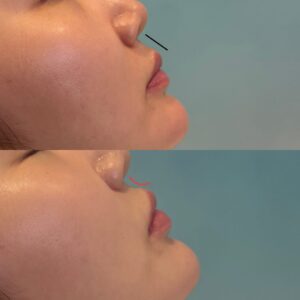 唇ヒアルロン酸は痛い？ダウンタイムは何日？医師解説と症例でリアルな痛み・腫れを完全解説